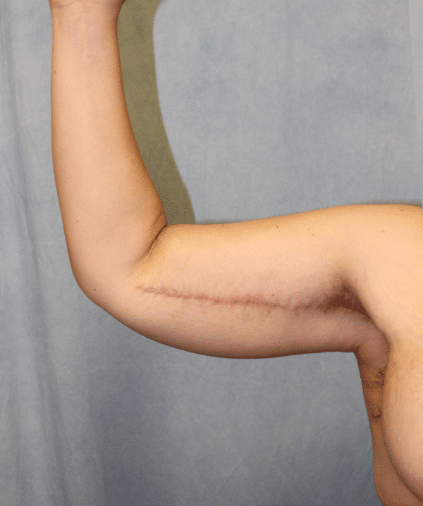 After Image: Case #4149 – Brachioplasty - front