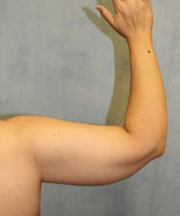 After Image: Case #4149 – Brachioplasty - back