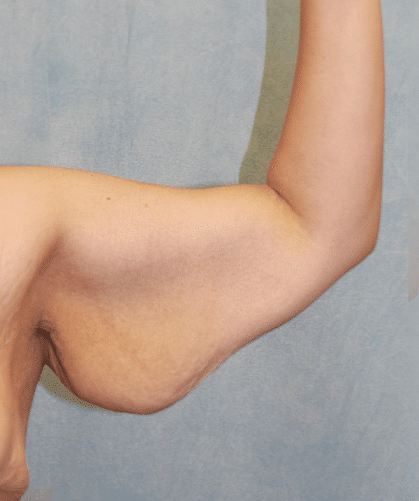 Before Image: Case #4149 – Brachioplasty - front