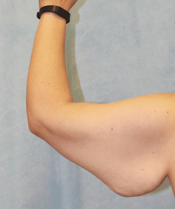 Before Image: Case #4149 – Brachioplasty - back