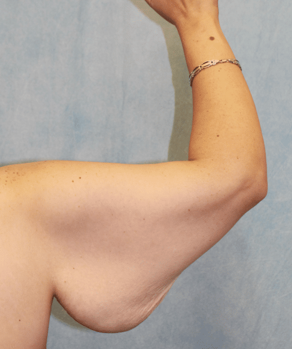 Before Image: Case #4149 – Brachioplasty - back