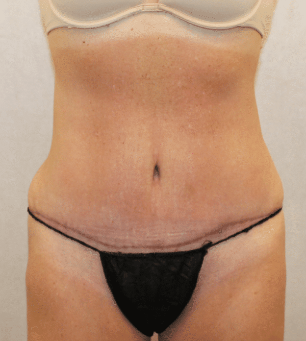 After Image: Case #4268 – Abdominoplasty – Tummy Tuck - front