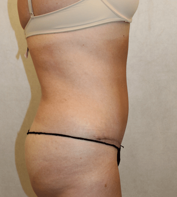 After Image: Case #4268 – Abdominoplasty – Tummy Tuck - right-side