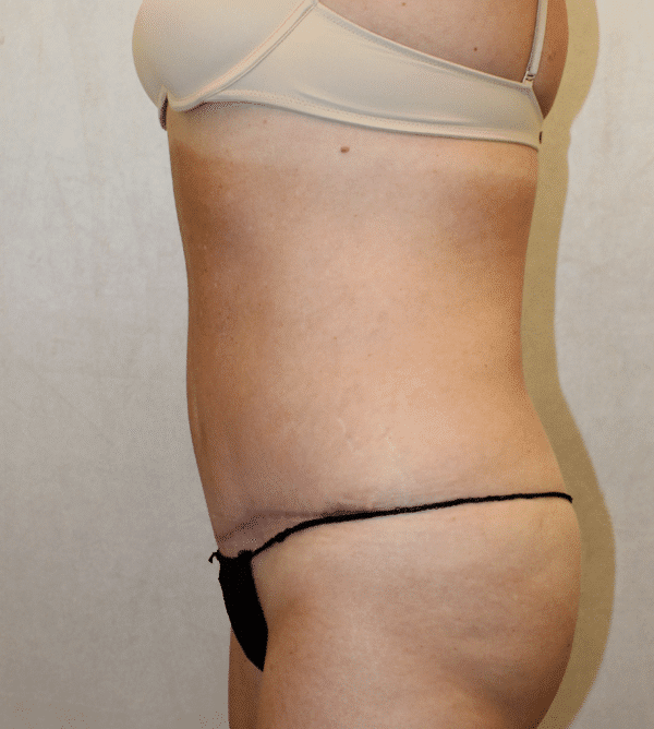 After Image: Case #4268 – Abdominoplasty – Tummy Tuck - left-side