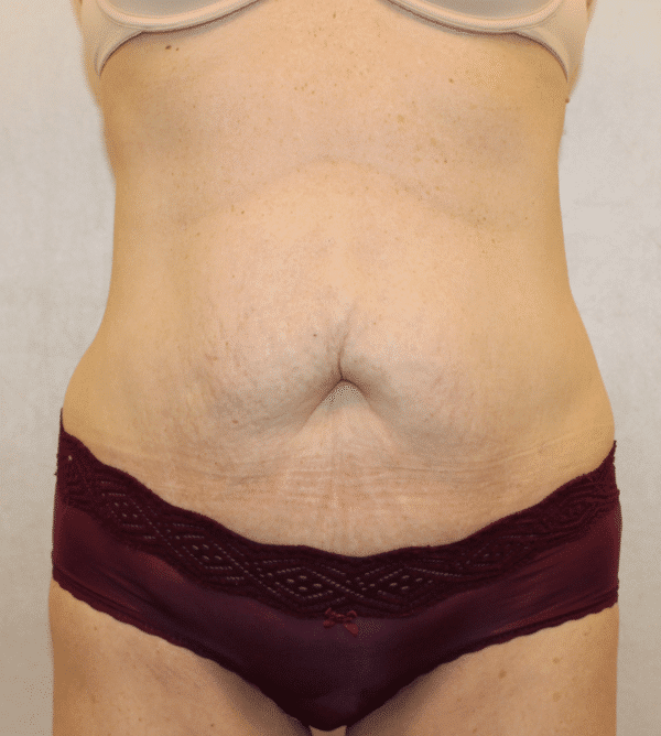 Before Image: Case #4268 – Abdominoplasty – Tummy Tuck - front