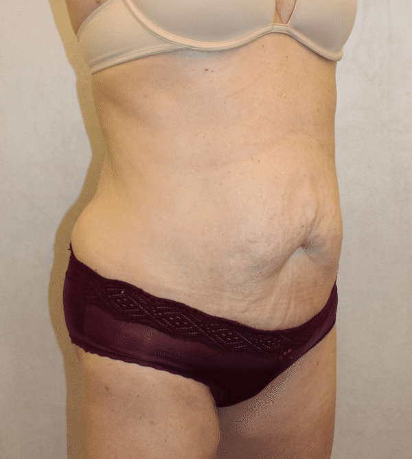 Before Image: Case #4268 – Abdominoplasty – Tummy Tuck - right-front-oblique