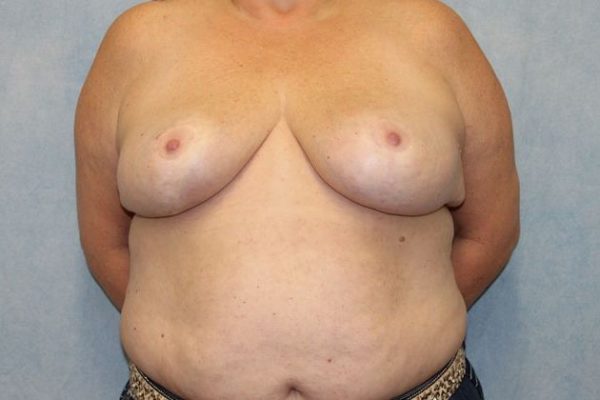 Case #442 – Breast Reduction