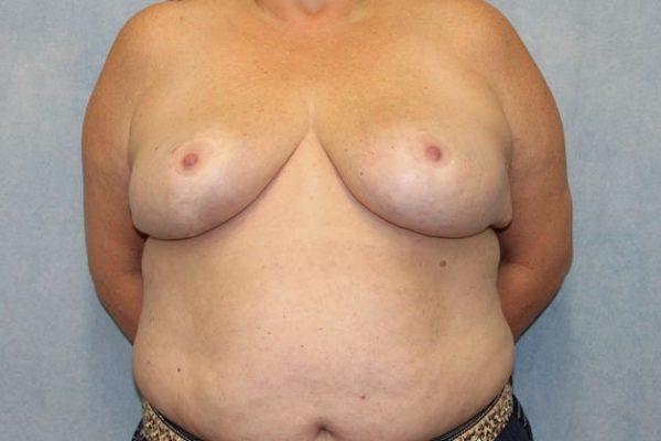 After Image: Case #442 – Breast Reduction - front