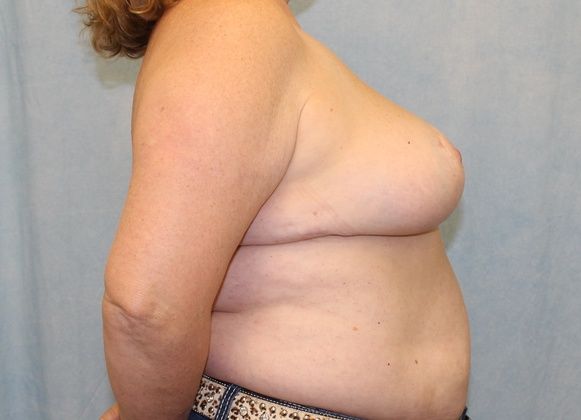 After Image: Case #442 – Breast Reduction - right-side