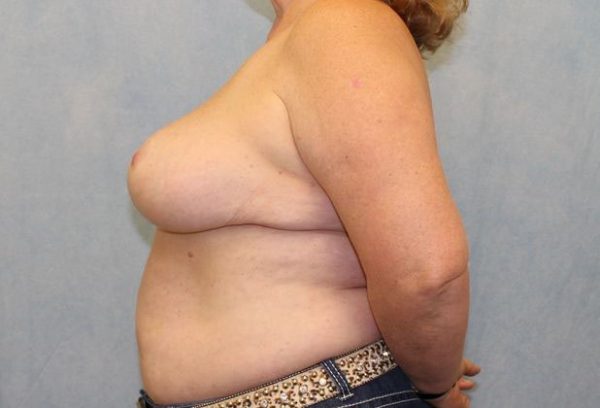 After Image: Case #442 – Breast Reduction - left-side