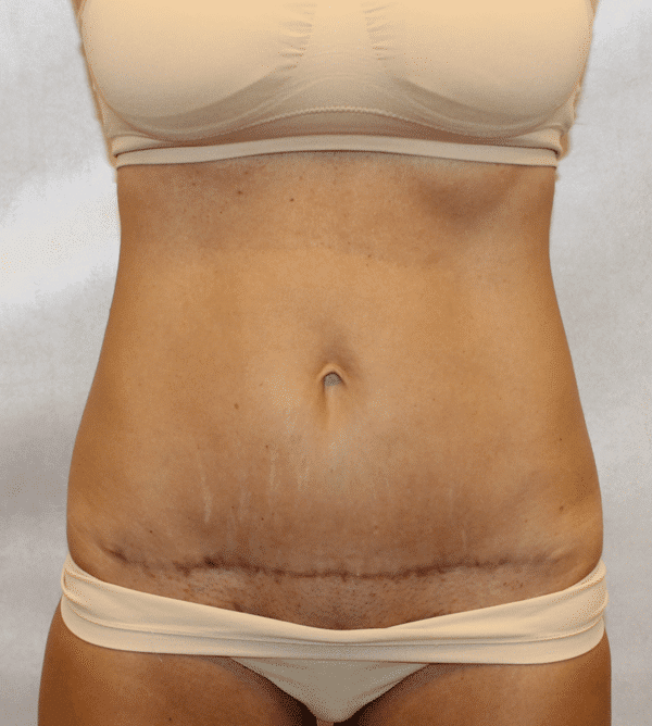 Case #4442 – Abdominoplasty – Tummy Tuck