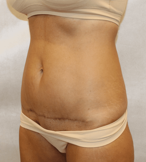After Image: Case #4442 – Abdominoplasty – Tummy Tuck - left-front-oblique