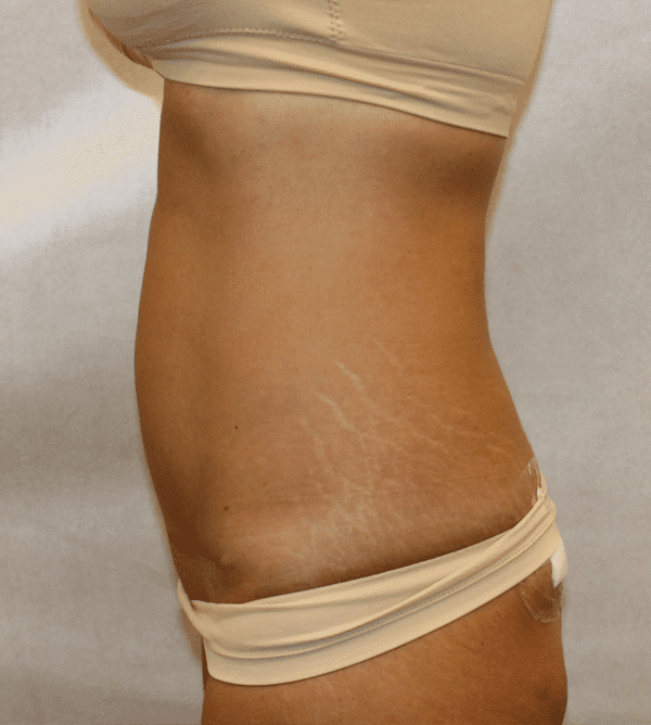After Image: Case #4442 – Abdominoplasty – Tummy Tuck - left-side