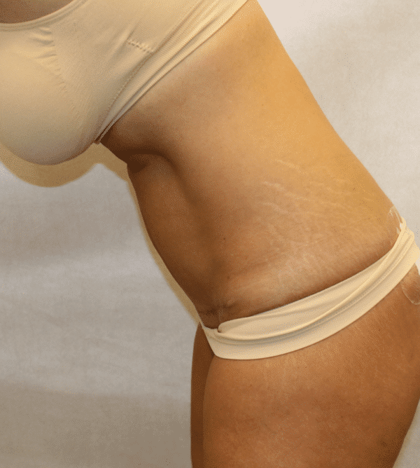 After Image: Case #4442 – Abdominoplasty – Tummy Tuck - left-front-oblique