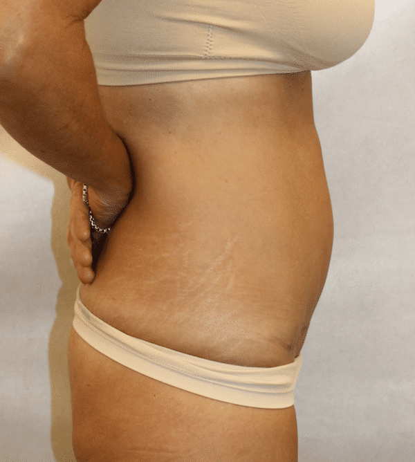 After Image: Case #4442 – Abdominoplasty – Tummy Tuck - right-side