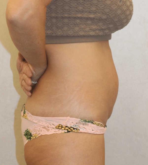 Before Image: Case #4442 – Abdominoplasty – Tummy Tuck - right-side