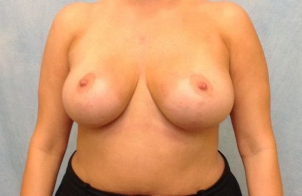 Case #454 – Breast Lift