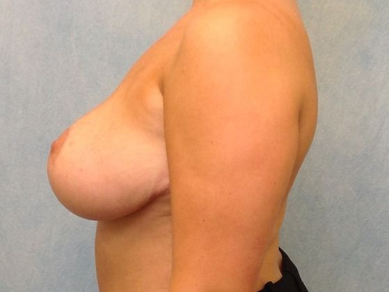 After Image: Case #454 – Breast Lift - left-side