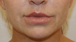 Case #4540 – Bullhorn Lip Lift