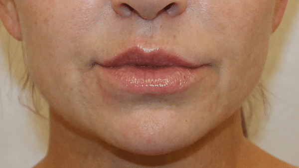 Case #4540 – Bullhorn Lip Lift
