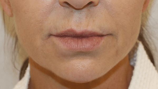 Before Image: Case #4540 – Bullhorn Lip Lift - front