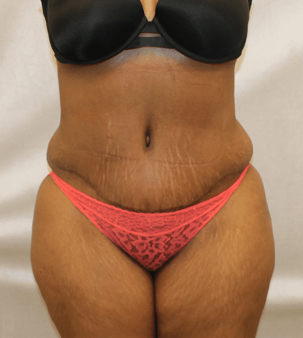 Case #4646 – Abdominoplasty – Tummy Tuck