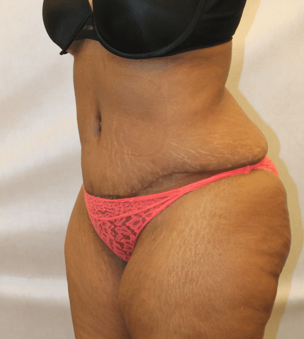 After Image: Case #4646 – Abdominoplasty – Tummy Tuck - left-front-oblique