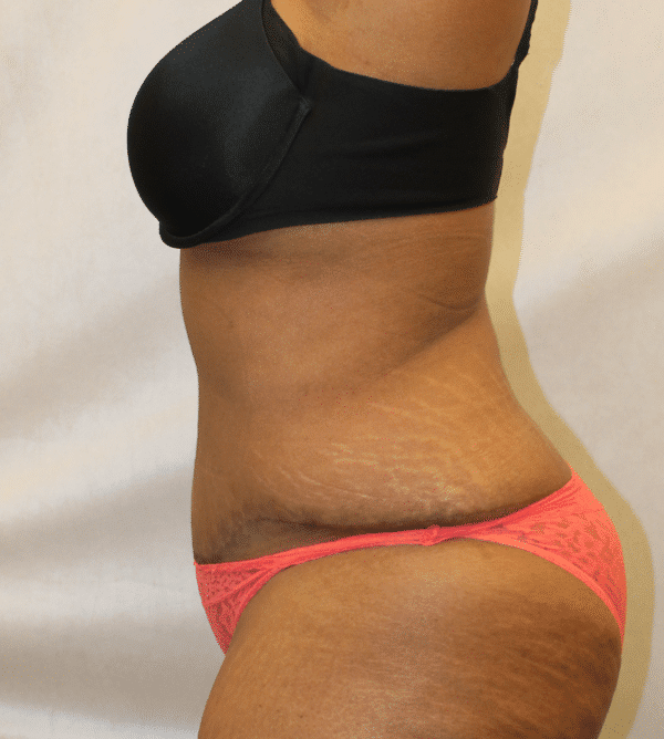 After Image: Case #4646 – Abdominoplasty – Tummy Tuck - left-side