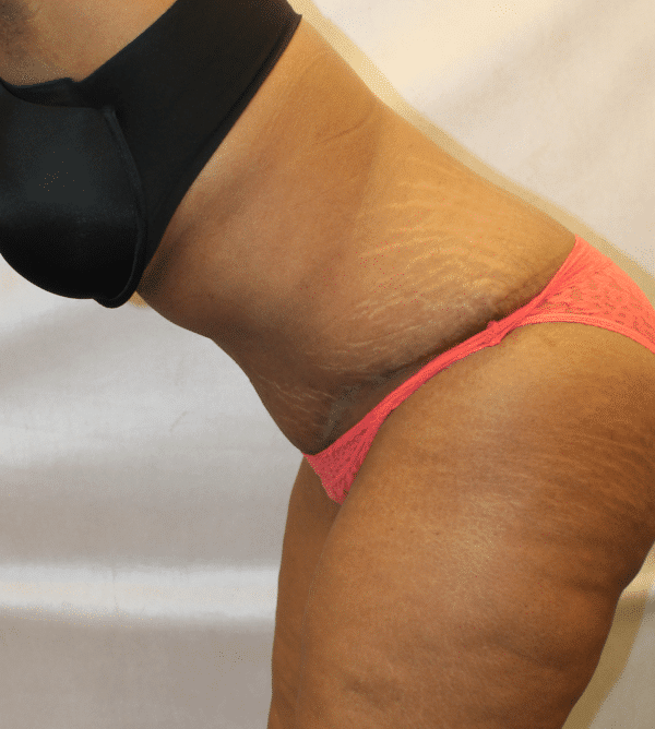 After Image: Case #4646 – Abdominoplasty – Tummy Tuck - left-front-oblique