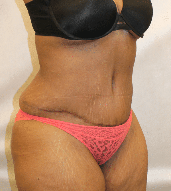 After Image: Case #4646 – Abdominoplasty – Tummy Tuck - right-front-oblique