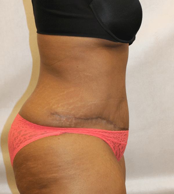 After Image: Case #4646 – Abdominoplasty – Tummy Tuck - right-side