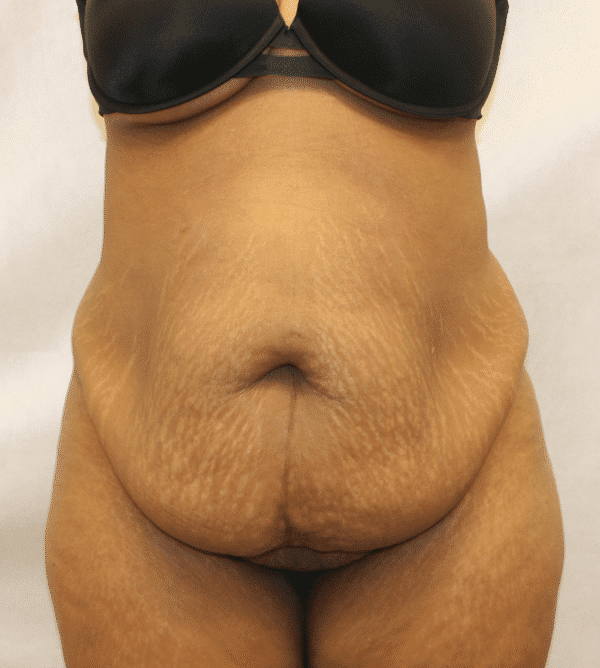 Before Image: Case #4646 – Abdominoplasty – Tummy Tuck - front