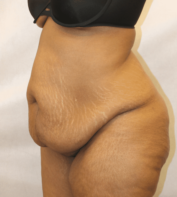 Before Image: Case #4646 – Abdominoplasty – Tummy Tuck - left-front-oblique