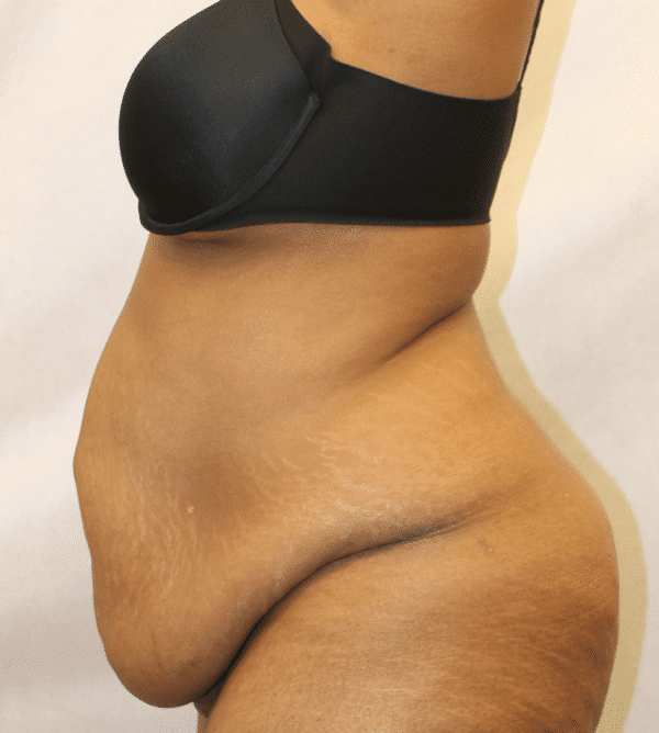 Before Image: Case #4646 – Abdominoplasty – Tummy Tuck - left-side