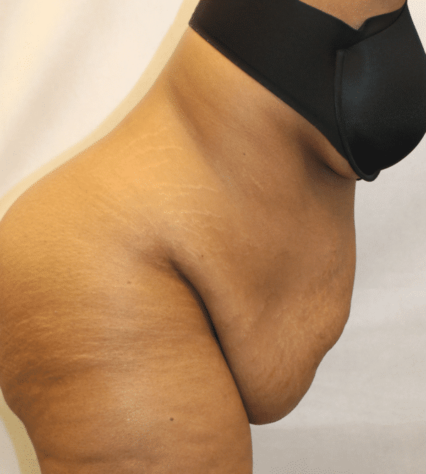 Before Image: Case #4646 – Abdominoplasty – Tummy Tuck - right-front-oblique