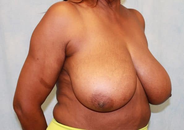 Before Image: Case #466 – Breast Reduction - right-front-oblique