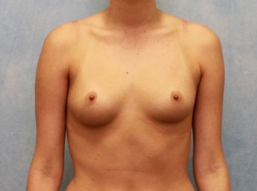 Before Image: Case #47 – Breast Augmentation - front