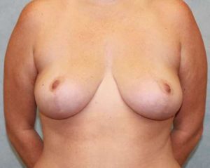 Case #478 – Breast Lift