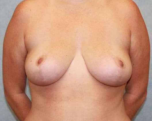 After Image: Case #478 – Breast Lift - front