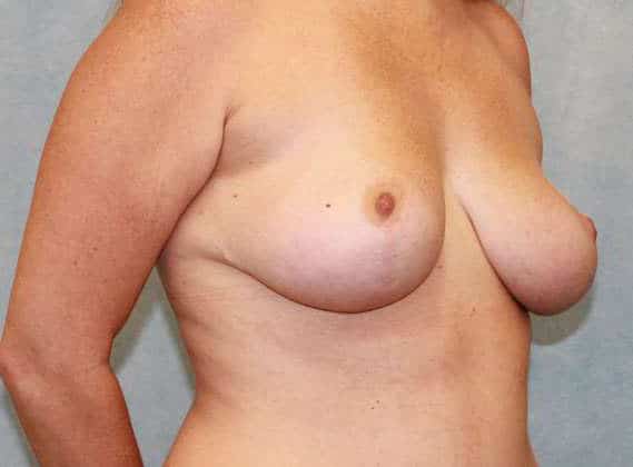 After Image: Case #478 – Breast Lift - right-front-oblique