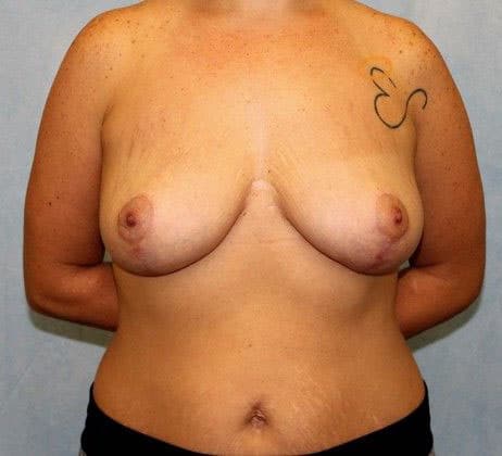 After Image: Case #490 – Breast Lift - front