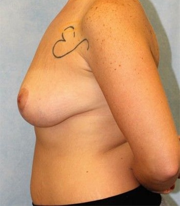 After Image: Case #490 – Breast Lift - left-side