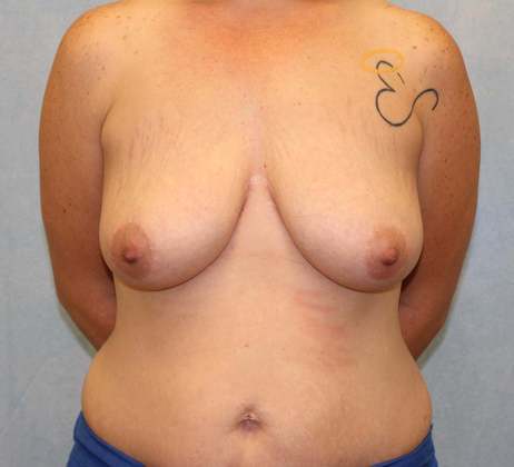 Case #490 – Breast Lift