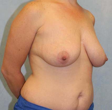 Before Image: Case #490 – Breast Lift - right-front-oblique