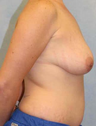 Before Image: Case #490 – Breast Lift - right-side