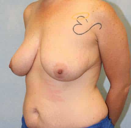 Before Image: Case #490 – Breast Lift - left-front-oblique
