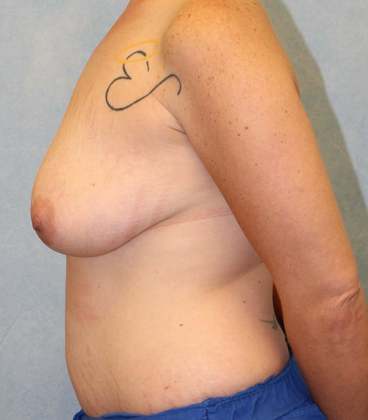 Before Image: Case #490 – Breast Lift - left-side