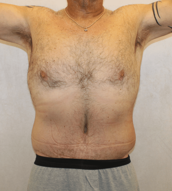 After Image: Case #4910 – Abdominoplasty – Tummy Tuck - front