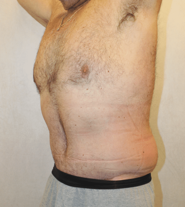 After Image: Case #4910 – Abdominoplasty – Tummy Tuck - left-front-oblique