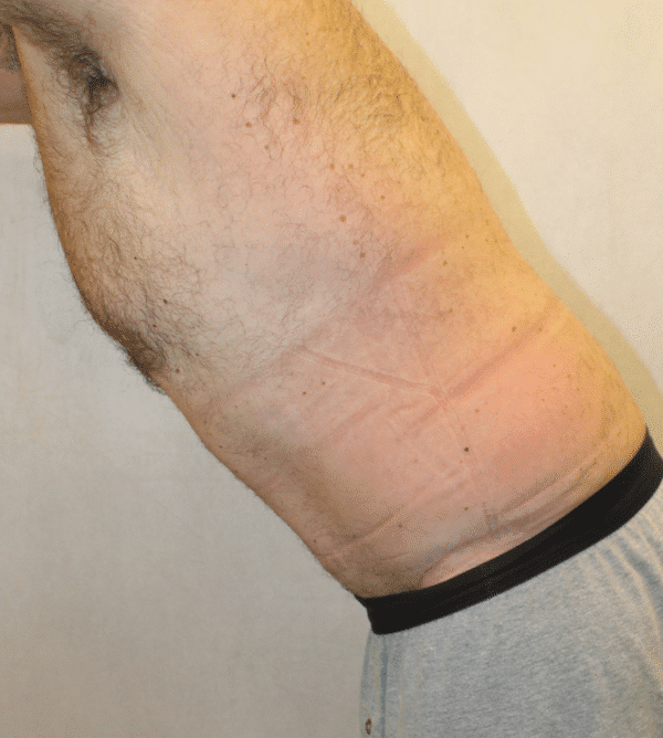After Image: Case #4910 – Abdominoplasty – Tummy Tuck - left-front-oblique